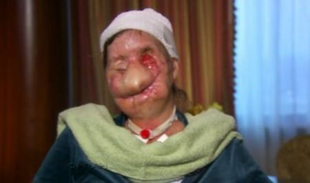 Charla Nash after chimp attack